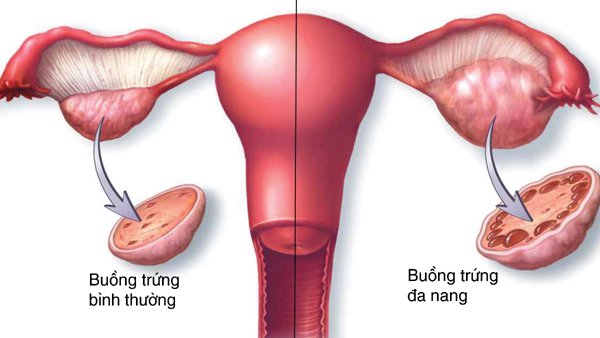 Buồng trứng có vai trò như thế nào với phụ nữ