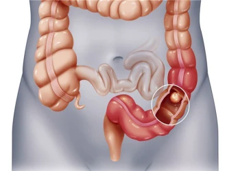 Các cách phát hiện sớm ung thư đại - trực tràng