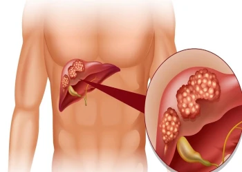 Tổng quan những điều cần biết về ung thư gan