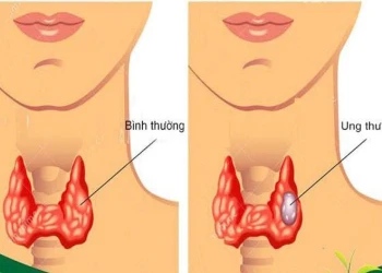 Một số loại ung thư có thể phát hiện sớm thông qua các biện pháp kiểm tra thông thường